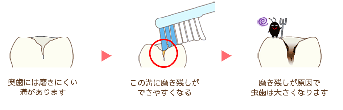 シーラント