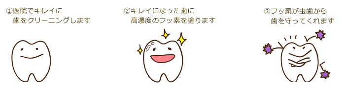 フッ素塗布