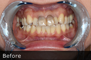 オールセラミック症例　治療前　元住吉の歯医者チェルシーデンタルクリニック